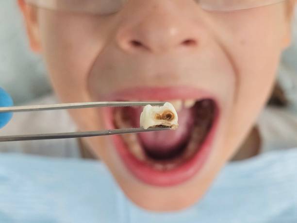 Best Emergency Treatment for Toothache in Florence Graham, CA