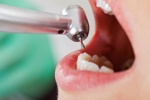 Best Emergency Tooth Extraction in Florence Graham, CA